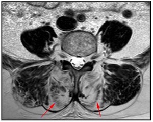 MRT- Querschnitt Rückenmuskulatur3