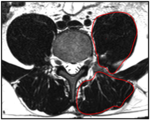 Querschnitt Rückenmuskel1
