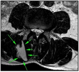 MRT- Querschnitt Rückenmuskulatur 2