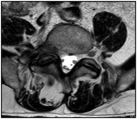 MRT- Querschnitt Rückenmuskulatur