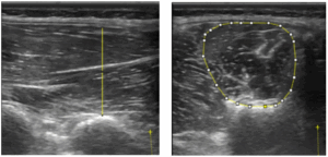 Grafik zum Muskelquerschnitt der Lumbalextensoren nach Training